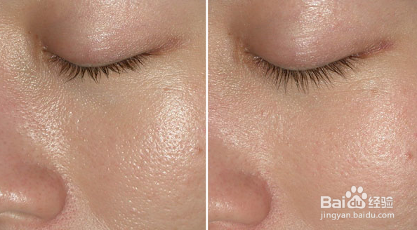 脸部毛孔粗大怎么办?个人经验