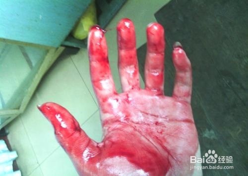 血友病有什么病症，会遗传吗？