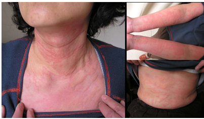 怎样早期发现甲亢