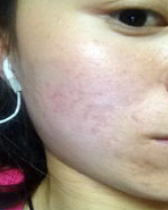 痘痘色素沉淀怎么去除