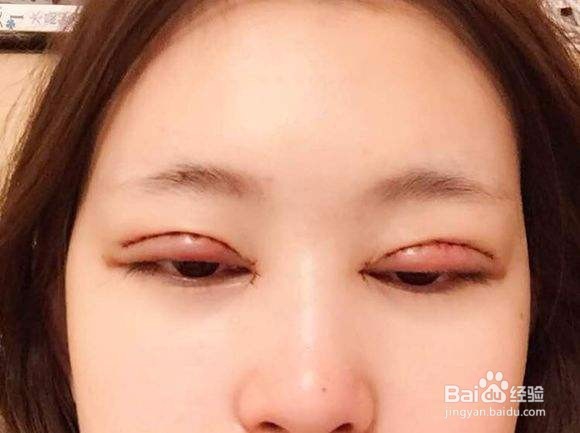 内双能割双眼皮吗