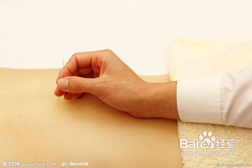 针灸减肥的原理要注意什么事项减肥的更健康
