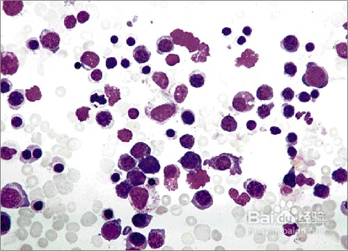细说溶血性贫血的诊断方法