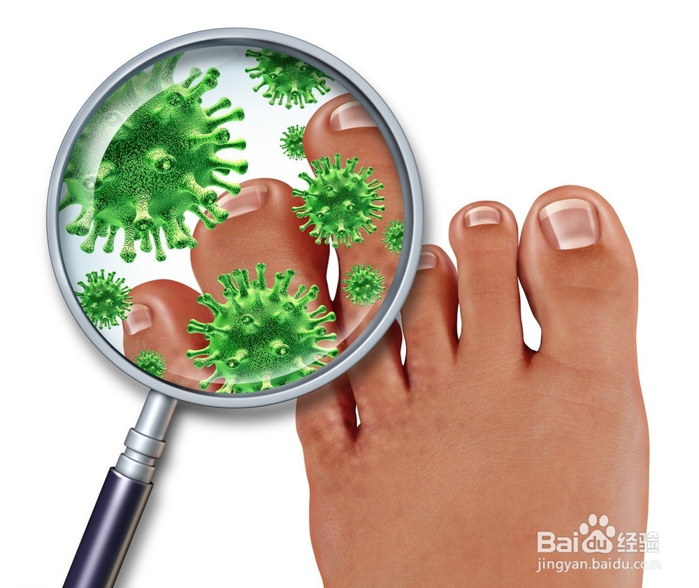 得了脚气怎么办？