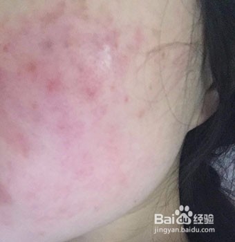 湿疹如何根治及禁忌