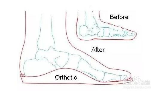 GOWITH：儿童扁平足改如何矫正