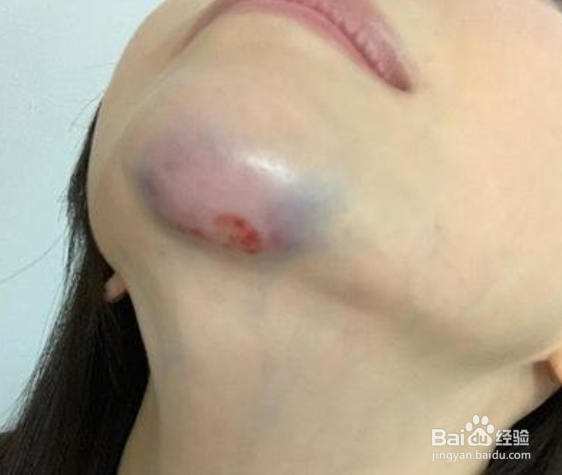 鸡蛋敷淤青正确做法