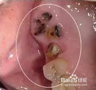哪些牙齿必须拔除