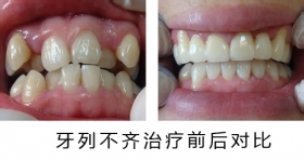 牙列不齐对生活造成的危害