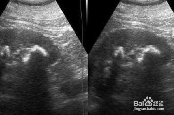 如何预防肾结石