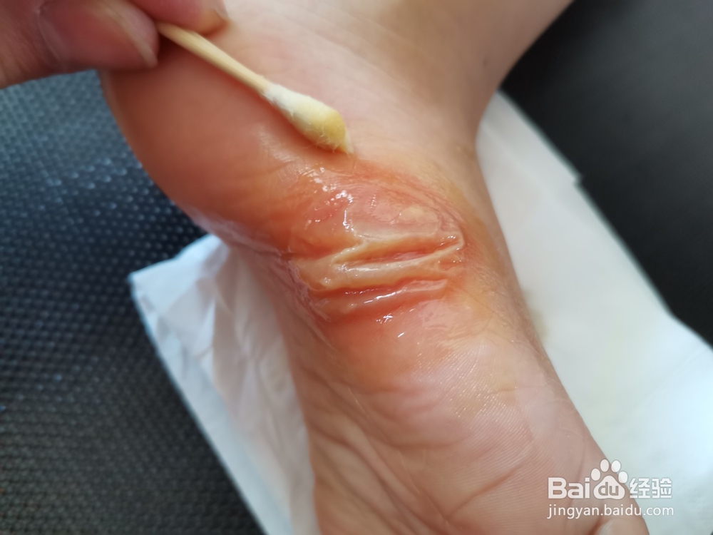 如何挑破脚上的大水泡