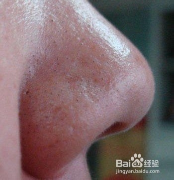 毛孔粗大是什么引起的?