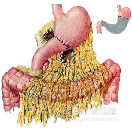 胃切除手术后恢复饮食注意事项