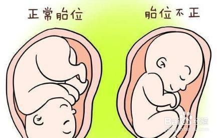 孕后期如何预防胎位不正