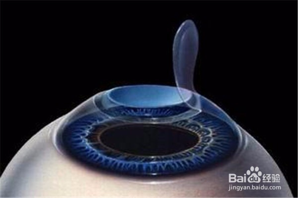 做完近视手术之后怎么恢复的技巧