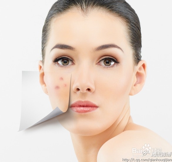 脸上长痘痘如何调理