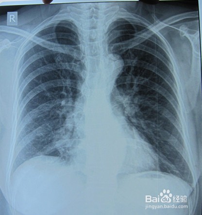 支气管肺炎的预防