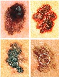 皮肤癌的形成原因有五种.