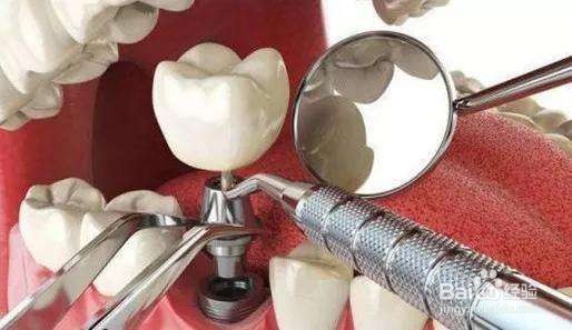 种植牙手术是如何操作的？