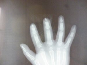 在工作中，右手中指被弄断上一节，算几级工伤，单位应该怎么补偿