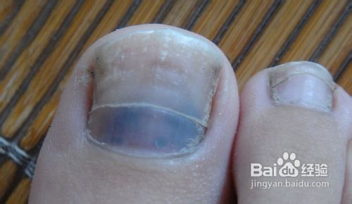 脚趾甲发白|是怎么回事|要怎么办