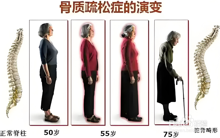 骨质疏松的风险因素与骨密度检查建议