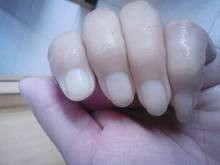 缺铁有哪些反应？应该如何补充？