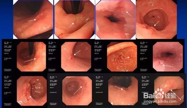体检浅表性胃炎怎么办？