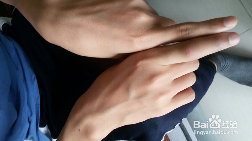 打篮球戳手指怎么处理?