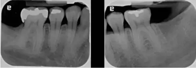 优梨美牙的牙周检查内容