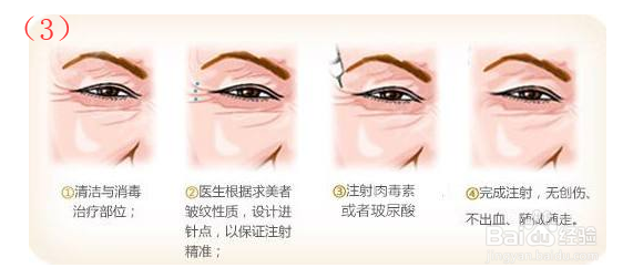 怎么去掉眼角纹