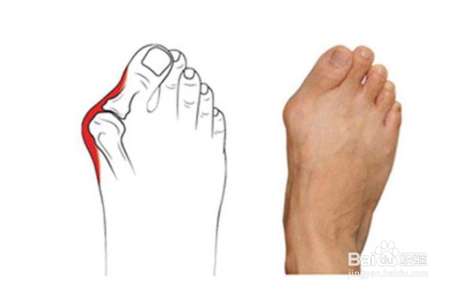 拇外翻如何治疗?