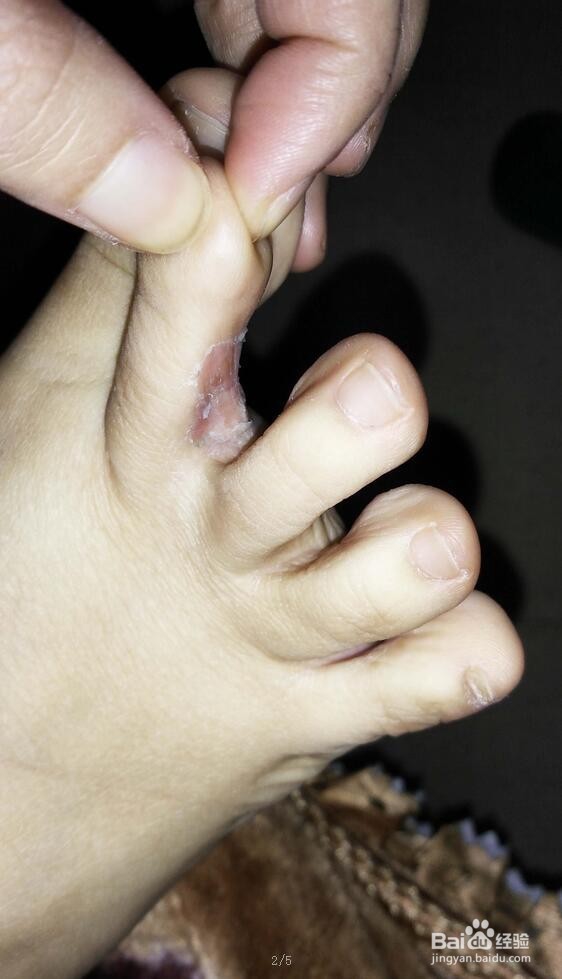 烂脚丫简单治疗法