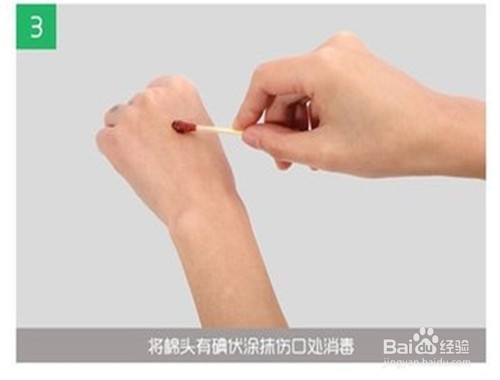 得了脂肪瘤自己该怎样做