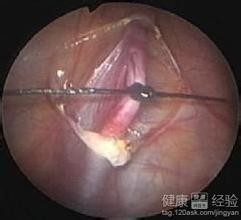 静脉曲张简介、预防、治疗