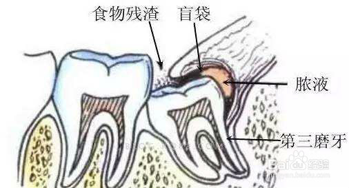 拨智齿过程和注意事项