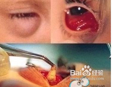 美瞳的危害眼睛长虫