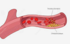 血栓,是怎么形成的?