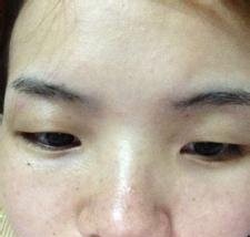 豆印变成黑点怎么去除