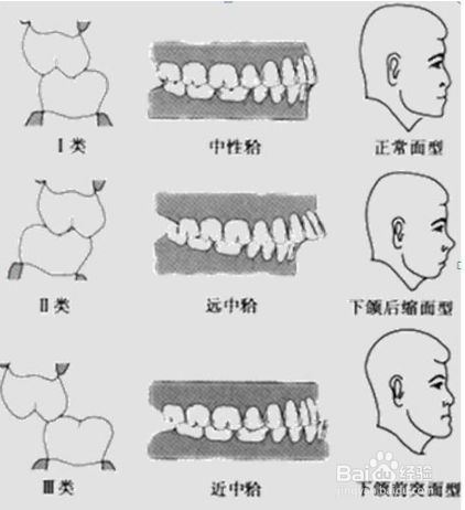 正畸安氏的一类二类三类怎样分