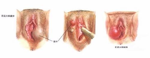 前庭大腺囊肿怎么办 百度经验