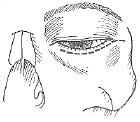 眼眶炎症的预防