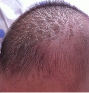 宝宝头上起皮怎么办