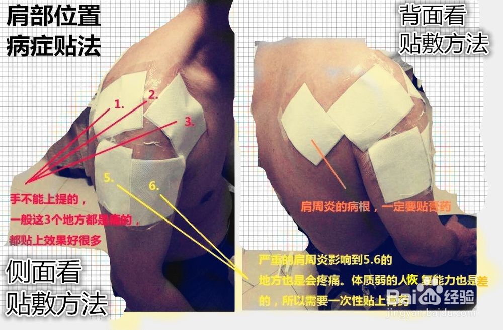 贴膏药注意的事项以及正确贴法