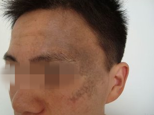 太田痣有什么危害?