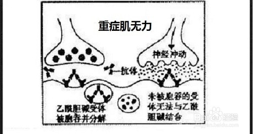 重症肌无力的七大诊断要点