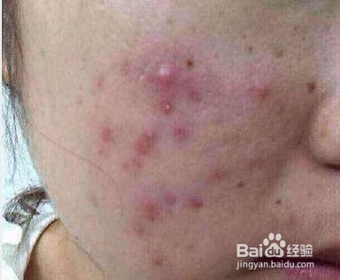 脸上痘痘怎么样快速消除(方法超实用)