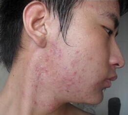 青春期时该怎样预防青春痘