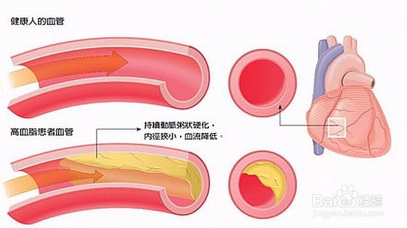 血管硬化的症状有哪些?如何预防血管硬化