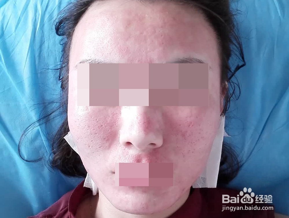 第一次做微针射频手术